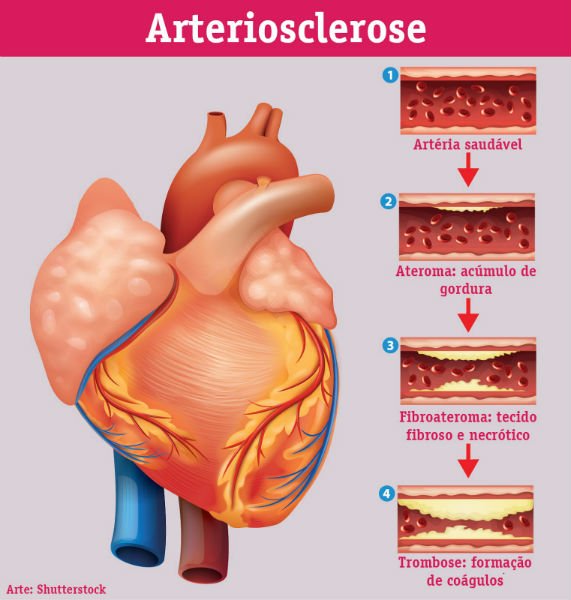 Aterosclerose