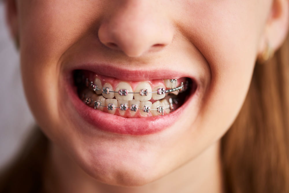 shot teeth with braces