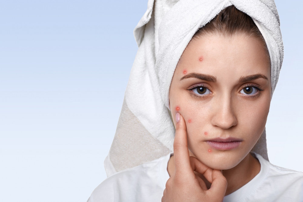 espinhas acne